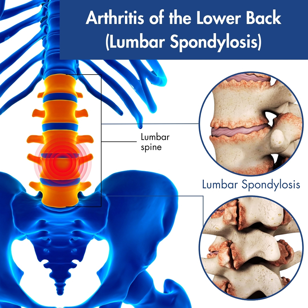 Arthritis of the Lower Back