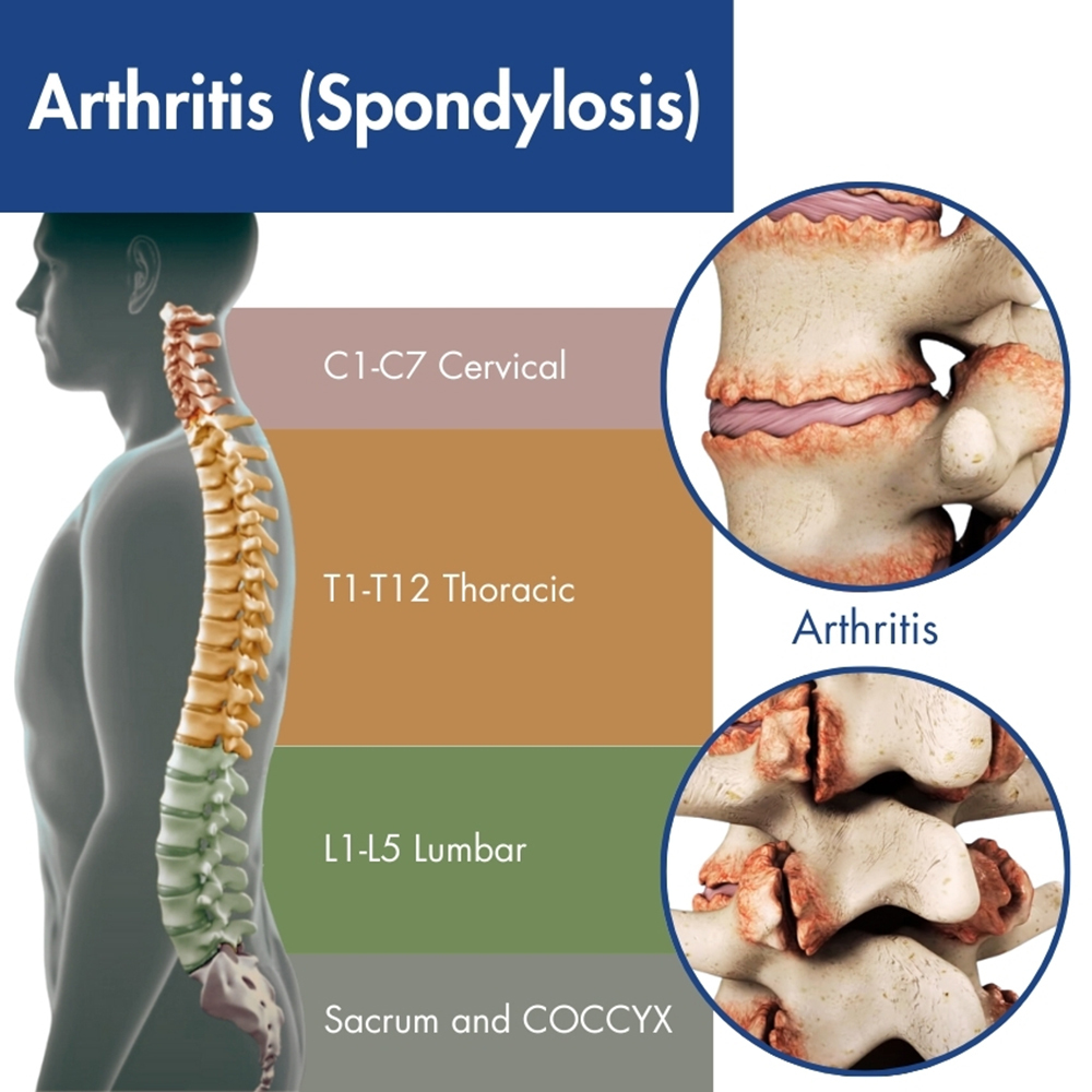Arthritis (Spondylosis)