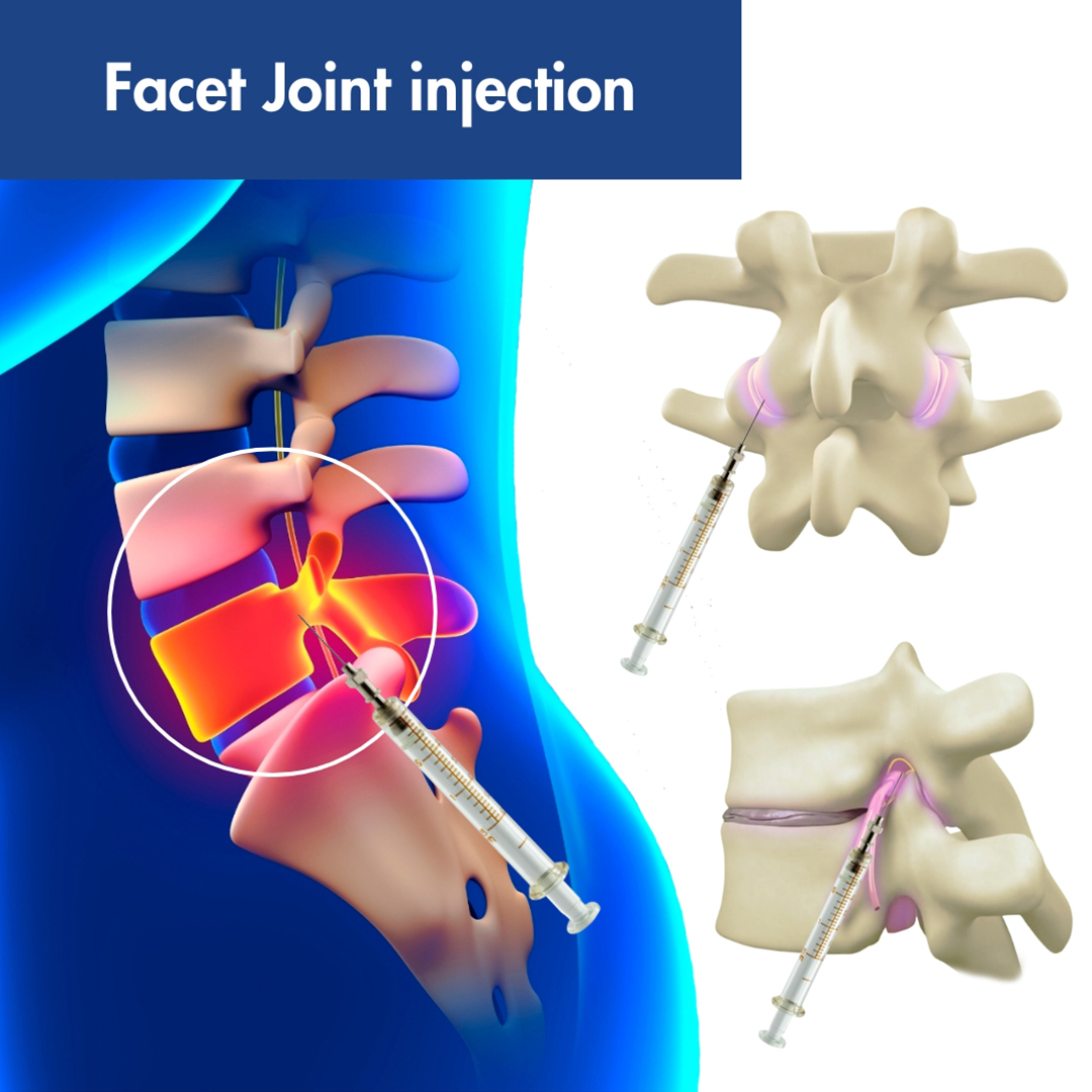 Facet Joint injection