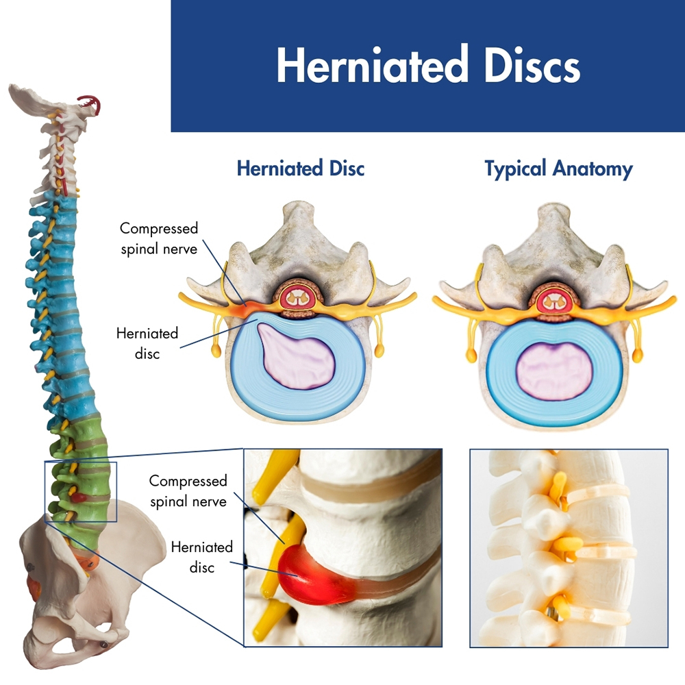 Herniated Disc Pain Treatment Madison WI Disc Herniation Doctor 
