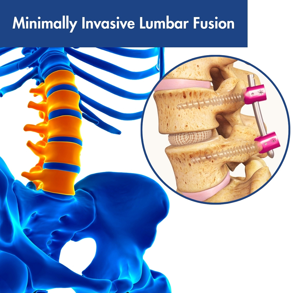 Minimally Invasive Lumbar Fusion