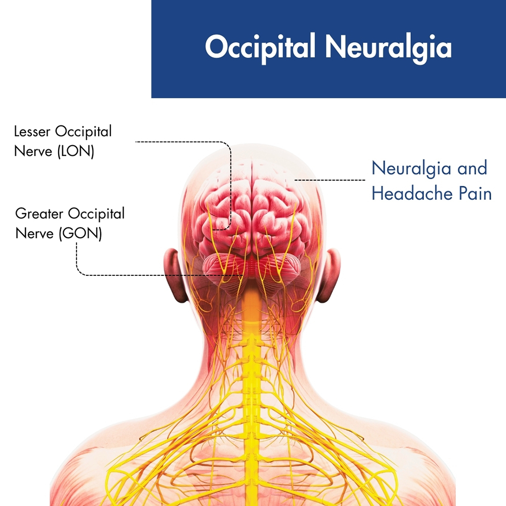 Occipital Neuralgia