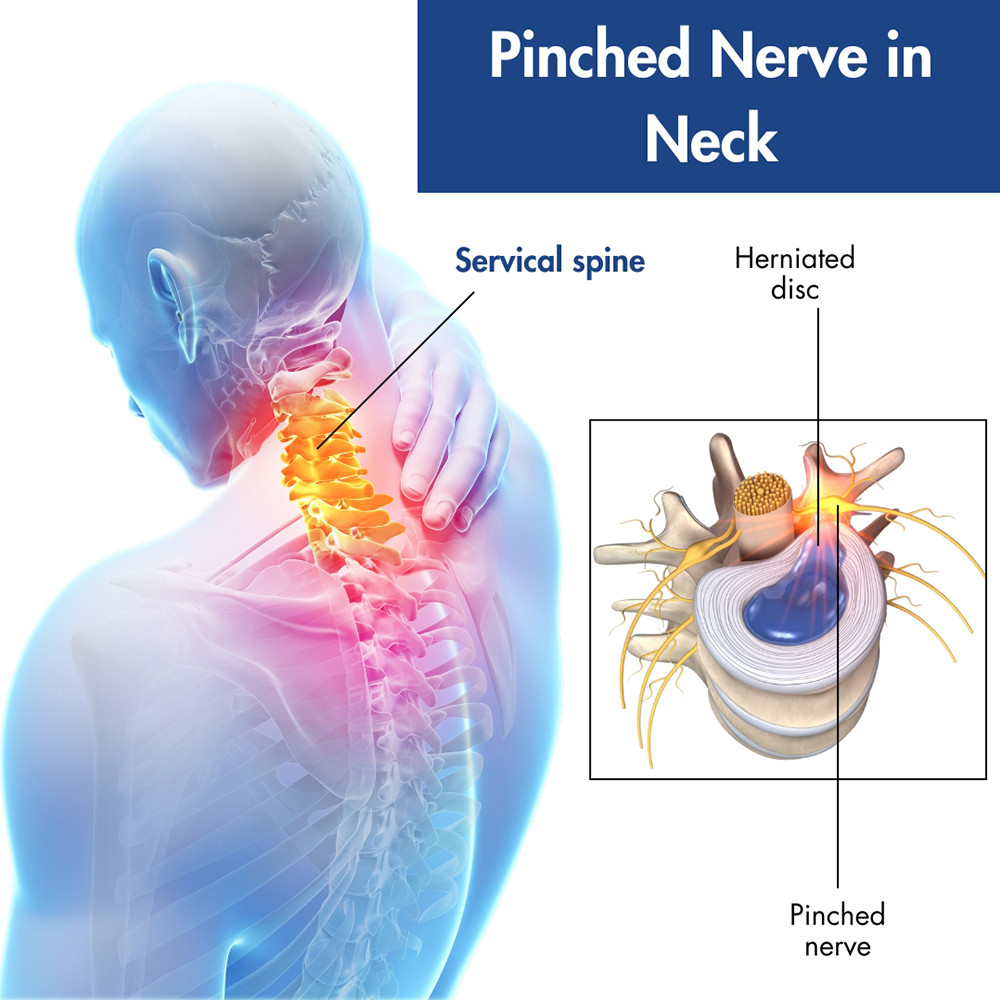 Pinched Nerve in the Neck