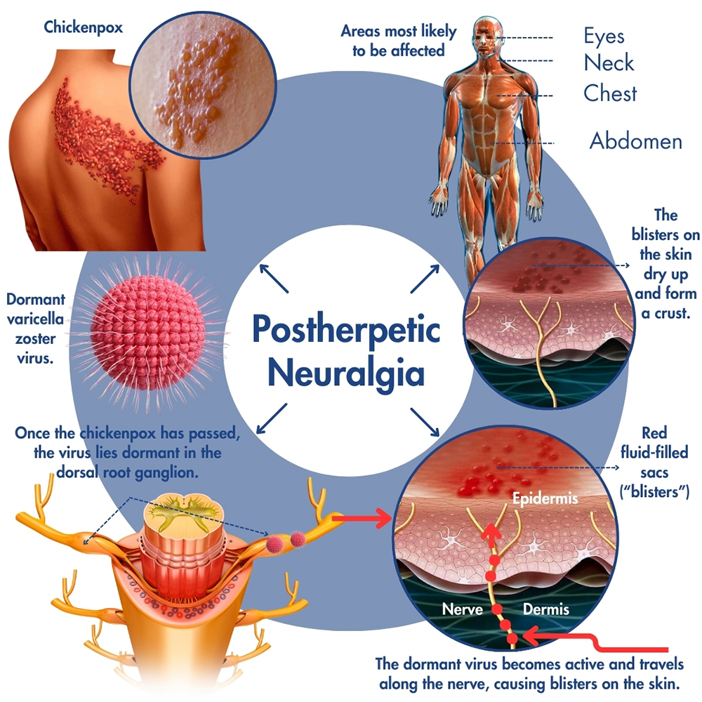 Postherpetic Neuralgia Treatment Madison WI Pro Spine Pain