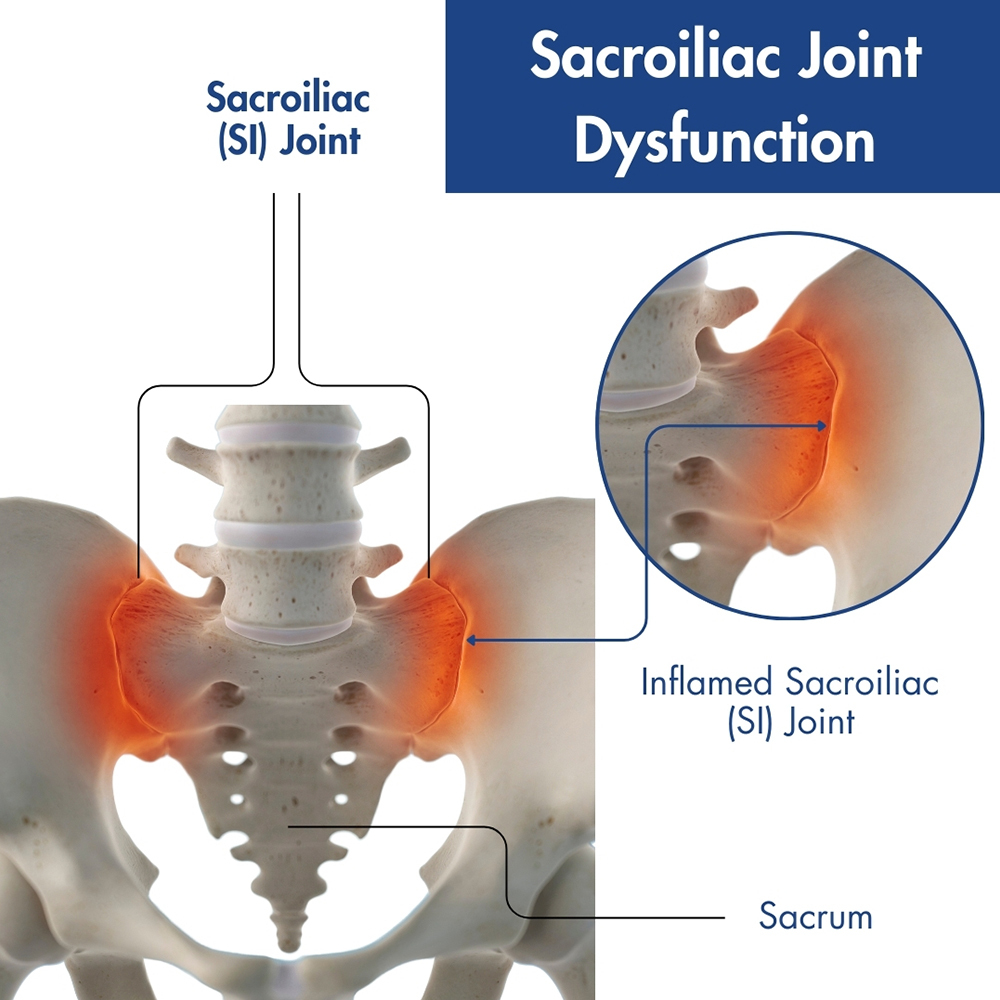 Sacroiliac Joint Dysfunction
