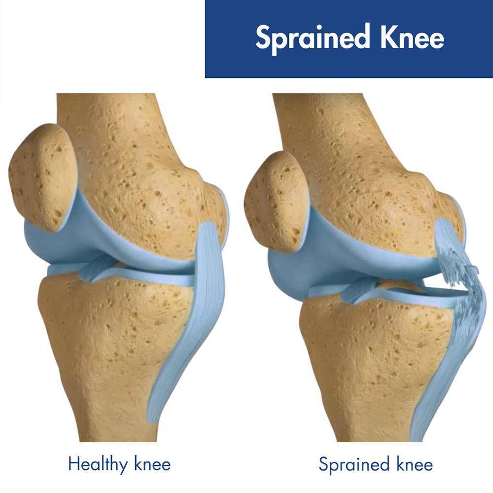 Sprained Knee