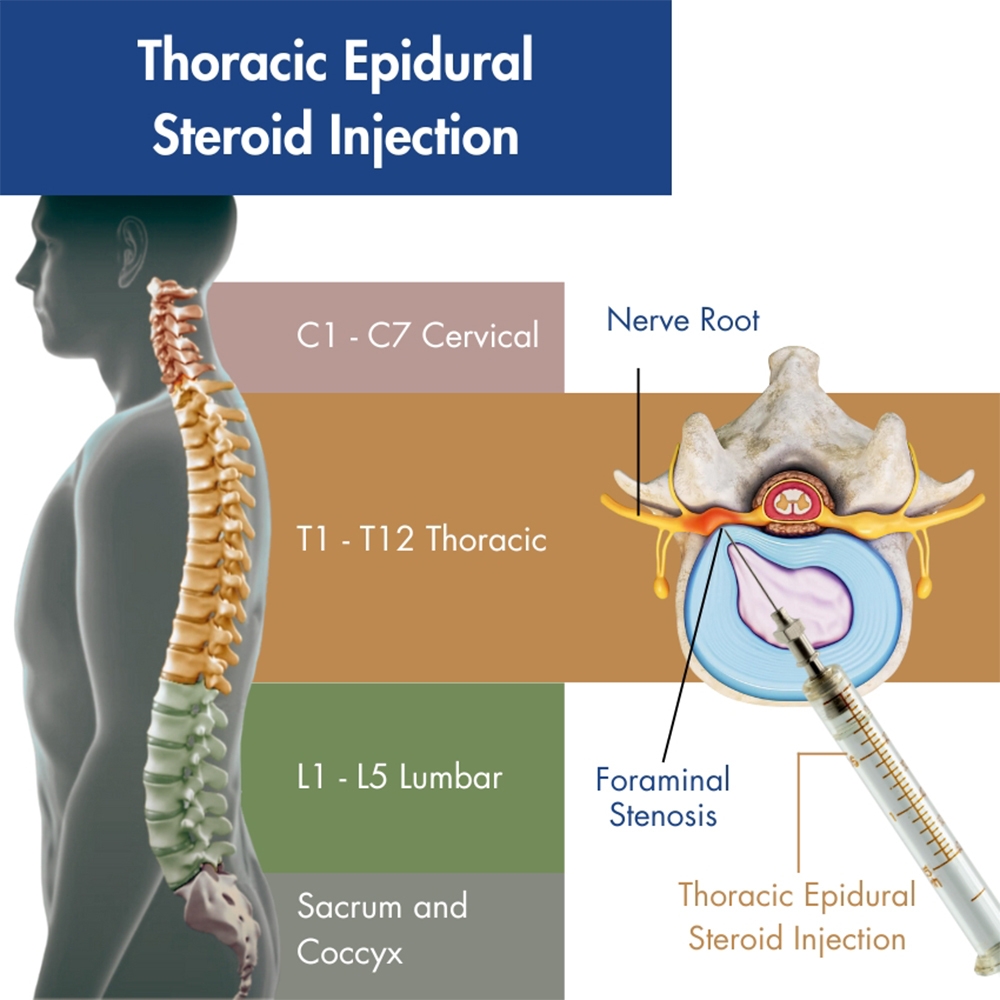 Thoracic Epidural Steroid Injection